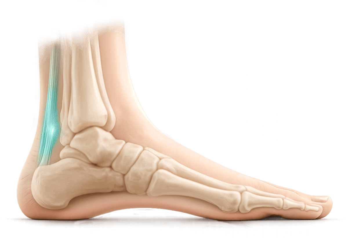 Achilles Tendinitis illustration