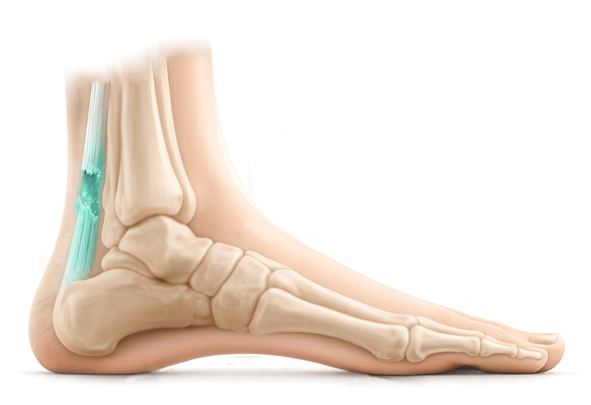 Achilles tendon rupture illustration